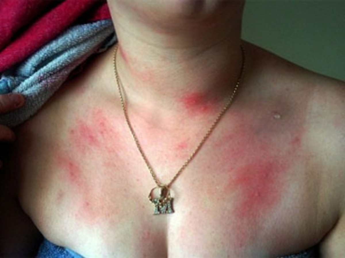Automedicación podría causar alergias graves la piel | El Informador
