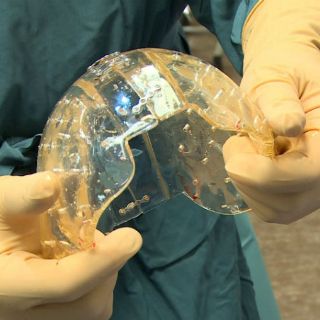 Implantan por primera vez un cráneo entero hecho con una impresora 3D