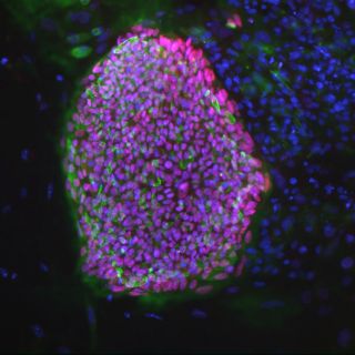 Crean células que producen insulina a partir del ADN de un diabético