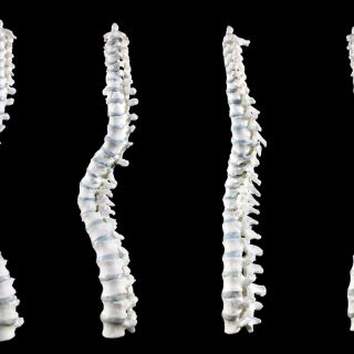 Médicos chinos implantan huesos fabricados en 3D