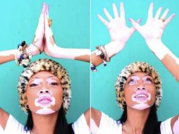 Winnie Harlow padece vitíligo,saltó a la fama en 'American's Next Top Model', y firmó un contrato con la marca Desigual. ESPECIAL /