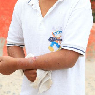 Por Río Sonora, 16 casos de dermatitis e intoxicación