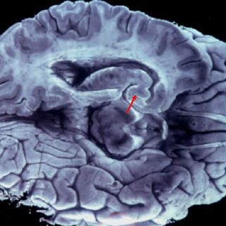 Llaman a fomentar donación de cerebros para investigar Alzheimer