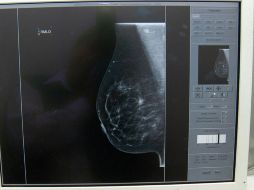 Jalisco es el quinto lugar nacional por número de muertes por cáncer de mama en 2014. NTX / ARCHIVO