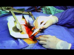 La fibrilación auricular es una enfermedad cardiaca, y al final es la causa de muerte cuando se presenta un infarto. NTX / ARCHIVO