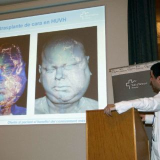Reconstruyen la cara a un hombre con tumor