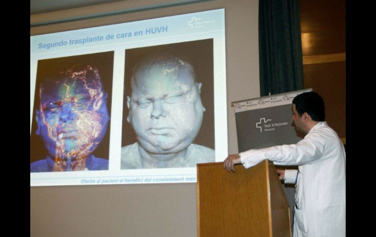 Es la primera vez en el mundo que se realiza al mismo tiempo la extirpación completa del tumor del paciente y el trasplante de cara. EFE / M. Pérez