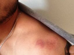 Zavala exhibió la marca que le dejó la arrebatada acción de Arango. INSTAGRAM / @flechazavala17