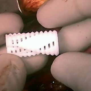 Tubo traqueal impreso en 3D salva a tres niños