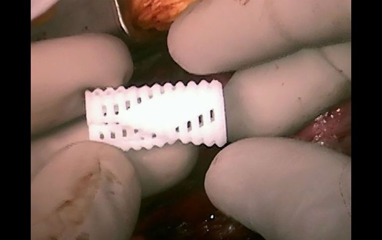 Esta prótesis experimental cambia de forma con el tiempo, crucial para niños en crecimiento. AP / U-M Health System Department of Communication