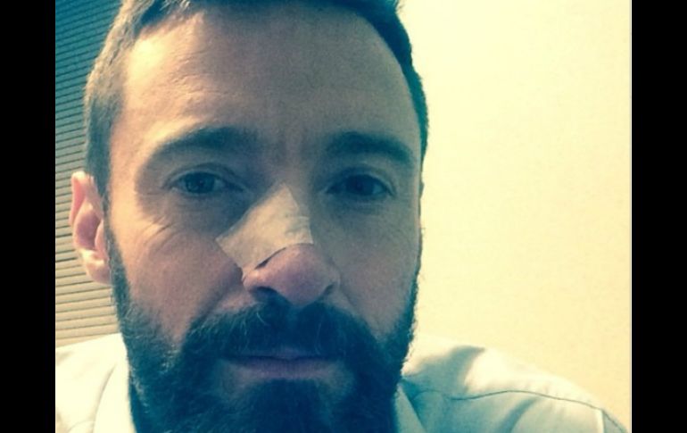 En 2013 fue diagnosticado con carcinoma de células basales, algo a lo que contribuyo el tiempo de tomar sol sin protección. INSTAGRAM / @thehughjackman