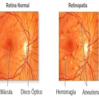 Vitamina E podría reducir retinopatía en niños
