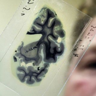 Estiman que esclerosis múltiple afecta a 14 mil mexicanos