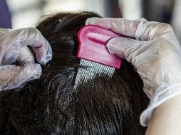 Dicho padecimiento produce lesiones dermatológicas en el cuero cabelludo. EL INFORMADOR / ARCHIVO