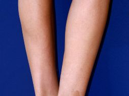 Los pacientes por lo regular atienden el problema cuando es visible. EFE / ARCHIVO