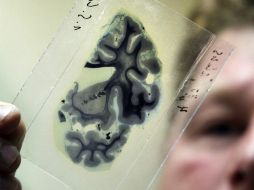 El tratamiento consiste en una fórmula libre de fenilalanina que proporciona los aminoácidos al cerebro. EFE / ARCHIVO