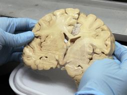 El procedimiento se enfoca en el estudio de imágenes del cerebro y del líquido cefalorraquideo. NTX / ARCHIVO