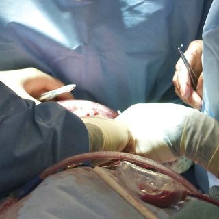 Médicos de hospital del ISSSTE transplantan hígado