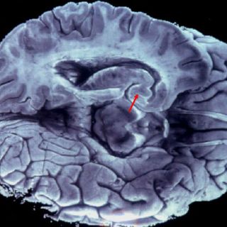 Pretenden 'hackear' el cerebro para curar males