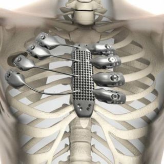 Médicos implantan caja torácica y esternón impresos en 3D