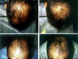 Entre los factores que contribuyen a la pérdida del cabello, el más común es el biológico. NTX / ARCHIVO