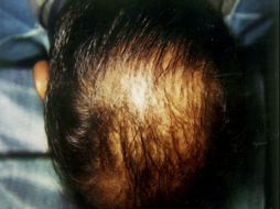Antes de hacer algo para prevenir la caída del cabello se debe conocer el padecimiento y consultar a un dermatólogo. NTX / ARCHIVO