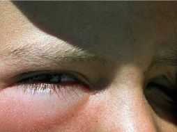La conjuntivitis es considerada una enfermedad de alta frecuencia y se debe a la contaminación del medio ambiente y a las alergias. EL INFORMADOR / ARCHIVO