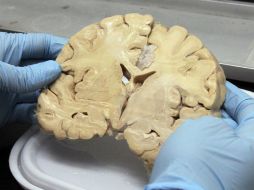 El Alzheimer es una enfermedad neurodegenerativa progresiva e irreversible que afecta las funciones de mayor complejidad en el cerebro. NTX / ARCHIVO