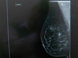 La cámara debe detectar por medio de la temperatura cuando las células cancerígenas se multiplican y crecen. NTX / ARCHIVO