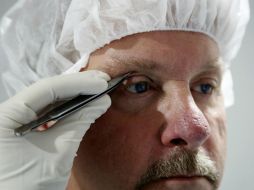 Los casos de parálisis facial tienen secuelas permanentes, como incapacidad para cerrar los ojos o sonreír. EFE / ARCHIVO