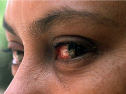 La conjuntivitis bacteriana requiere tratamiento médico de dos semanas para desaparecer. EL INFORMADOR / ARCHIVO