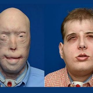 Bombero desfigurado se somete al trasplante más completo de cara