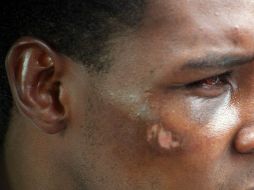 Algunos remedios, además de marcas en la piel e ingflamación, ayudan a combatir el dolor. EL INFORMADOR / ARCHIVO