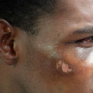 Recomendaciones para desinflamar un golpe