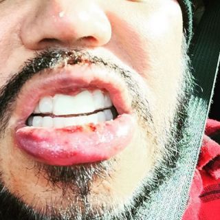 A.B. Quintanilla se rompe los dientes en una borrachera