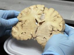 La hinchazón del cerebro está ligada con el desarrollo de la patología. NTX / ARCHIVO