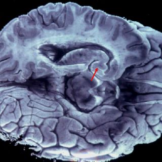 Es posible recuperar conexiones cerebrales perdidas: estudio