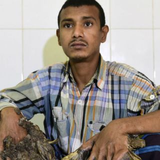 Hospital de Bangladesh se prepara para operar al 'hombre árbol'