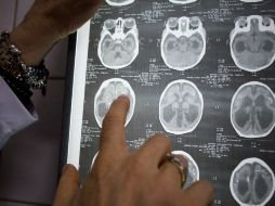 Investigadores encontraron que el cerebro fetal era de una fracción del tamaño normal y carecía de los pliegues neurales comunes. NTX / ARCHIVO