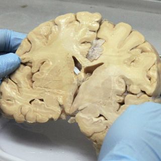 Crean libro para tratar pacientes con Alzheimer y Parkinson