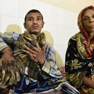 El 'hombre árbol' es operado con éxito en Bangladesh