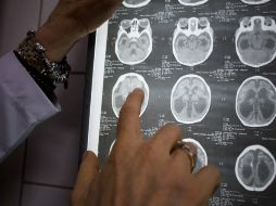 El cerebro es tan rápido que a partir de recibir la información 'negativa', da respuesta con una enfermedad. NTX / ARCHIVO