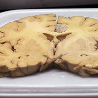 Una molécula podría ayudar a combatir el Alzheimer