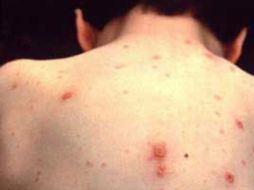 La mayoría de los casos de varicela ocurren en la niñez. ESPECIAL / ARCHIVO