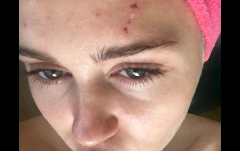 Se puede ver a la cantante con rasguños en distintas partes del cuerpo. INSTAGRAM / mileycyrus