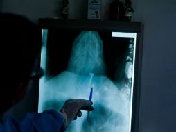 La probabilidad de que padezcan lesiones de piel es mucho más alta que sus colegas no expuestos a radiación. AFP / ARCHIVO