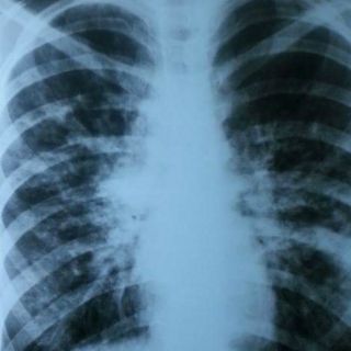 Diagnóstico tardío de fibrosis quística reduce expectativa de vida