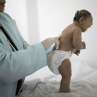 Estudian problemas neurológicos relacionados con zika