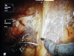 El dispositivo para 'suturar tejido' cuenta con brazos que llegan a las aberturas más pequeñas en el cuerpo. NTX / ARCHIVO