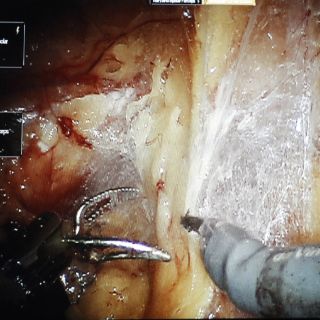 Robot sutura tejido por sí mismo